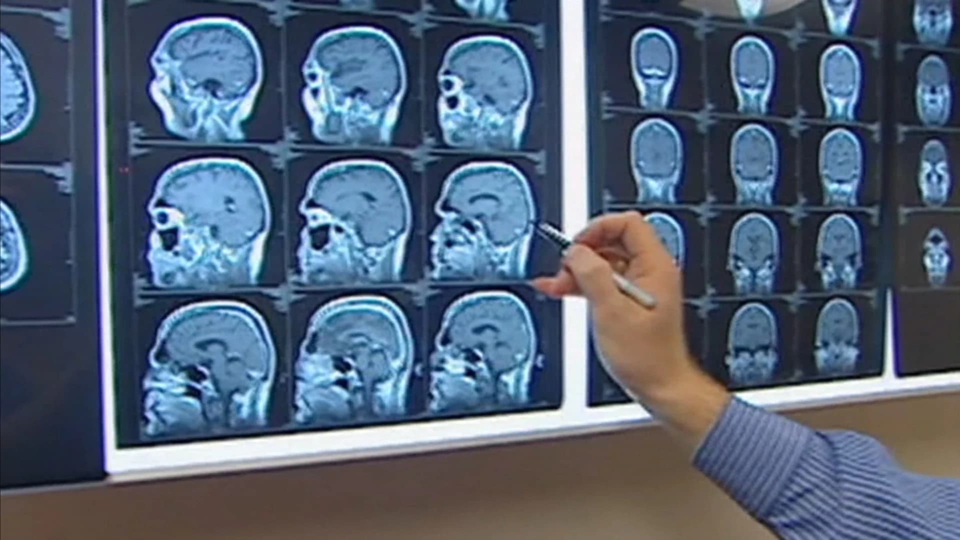 Study: Nearly 200 former football players show signs of brain disease